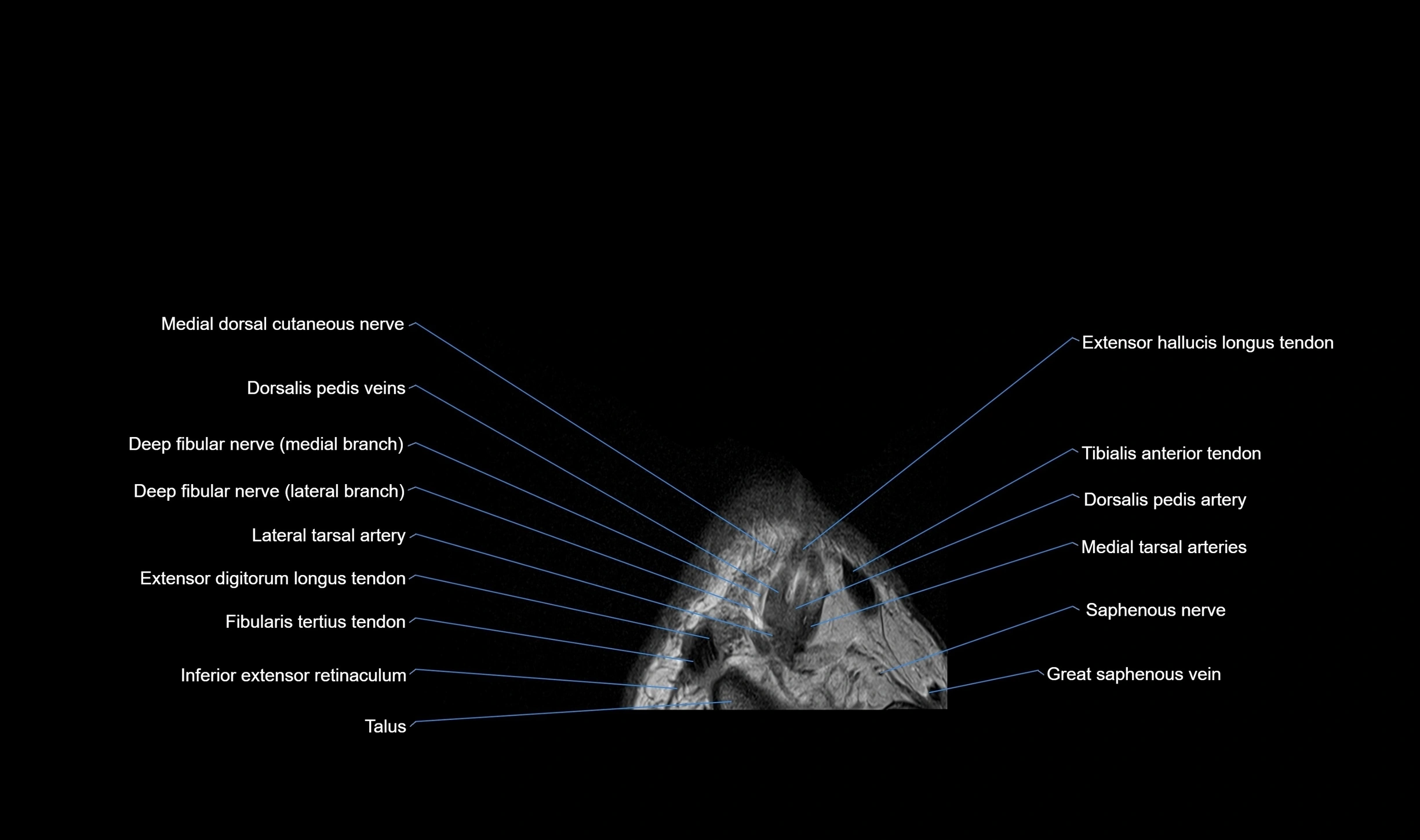 MRI mid foot coronal ligaments cross sectional anatomy 3T  radiology  image-img-00001-00006.webp